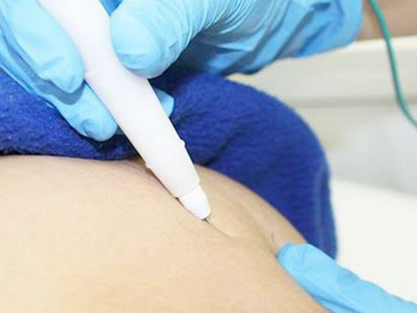 Electrolisis Percutánea